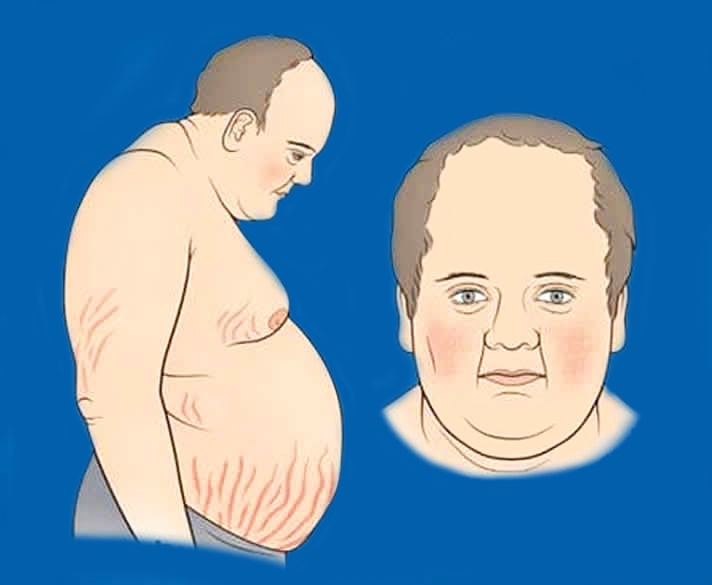 cushing-syndrome