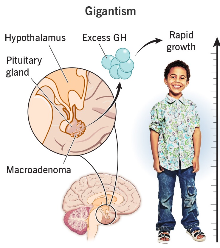 gigantism