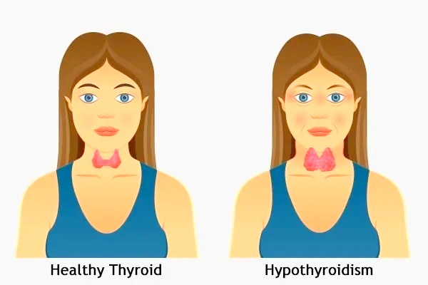 hypothyroidism
