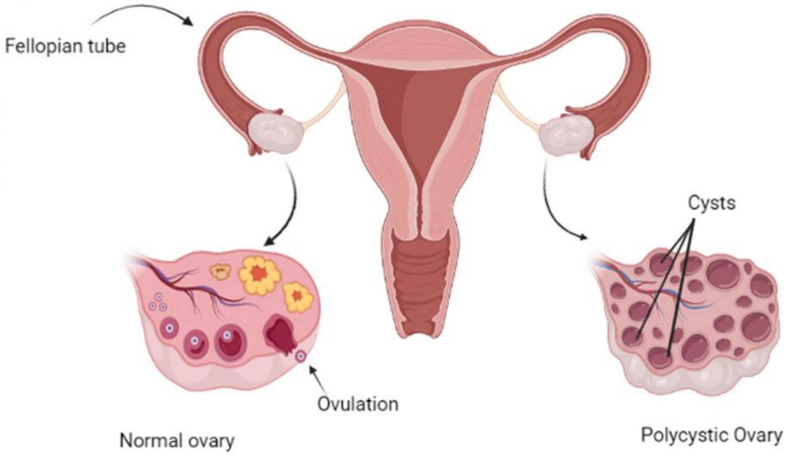 pcos