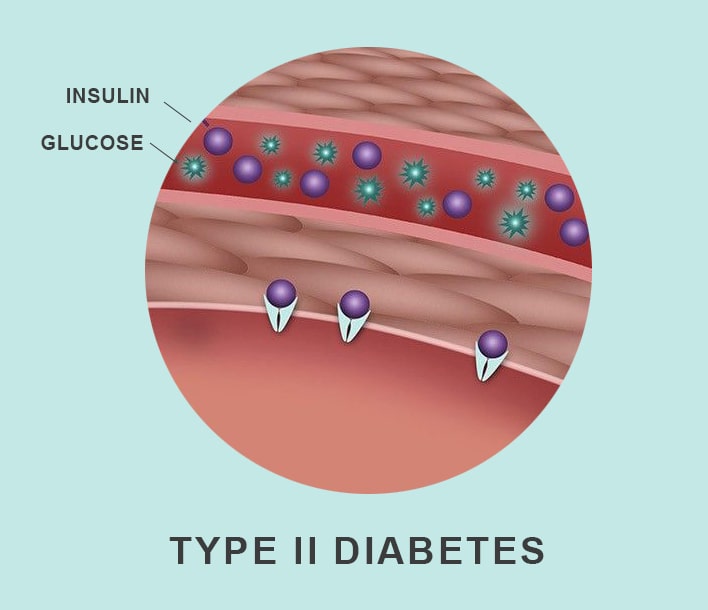 type ll diabetes
